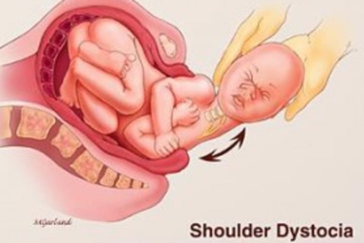 shoulderdyst.png