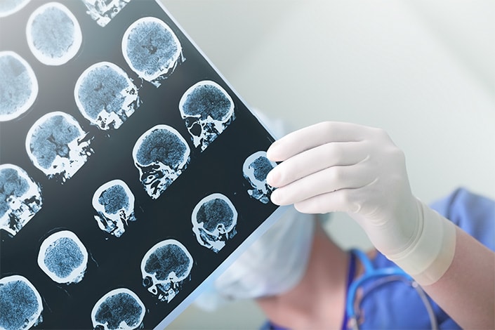 Types of Traumatic Brain Injuries