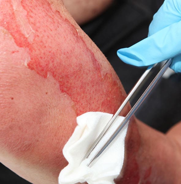 5 Things You Should Never Do After a Serious Burn