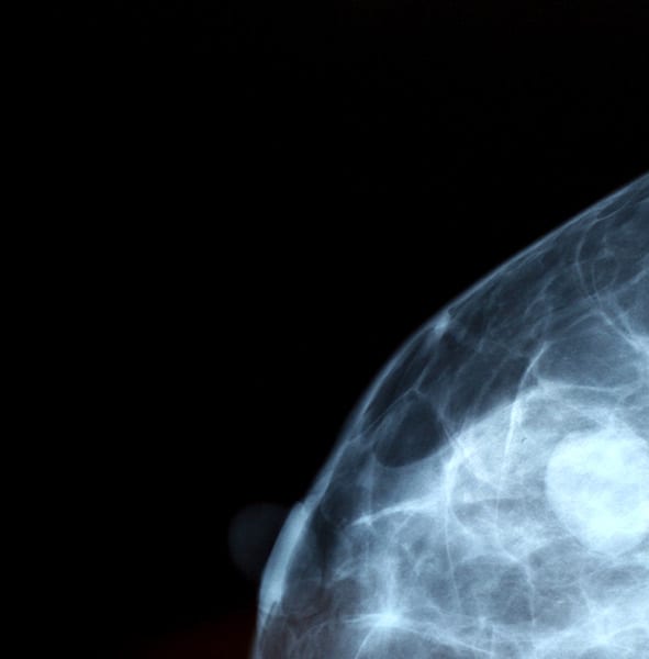 mammogram.jpg