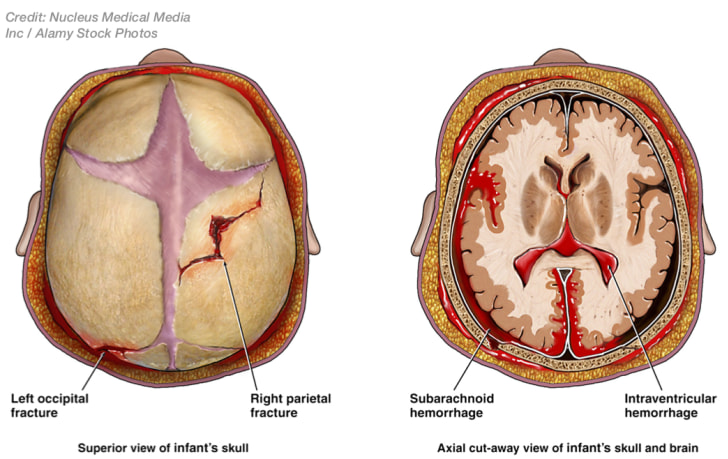 Birth Injuries Caused by Vacuum Extraction Complications