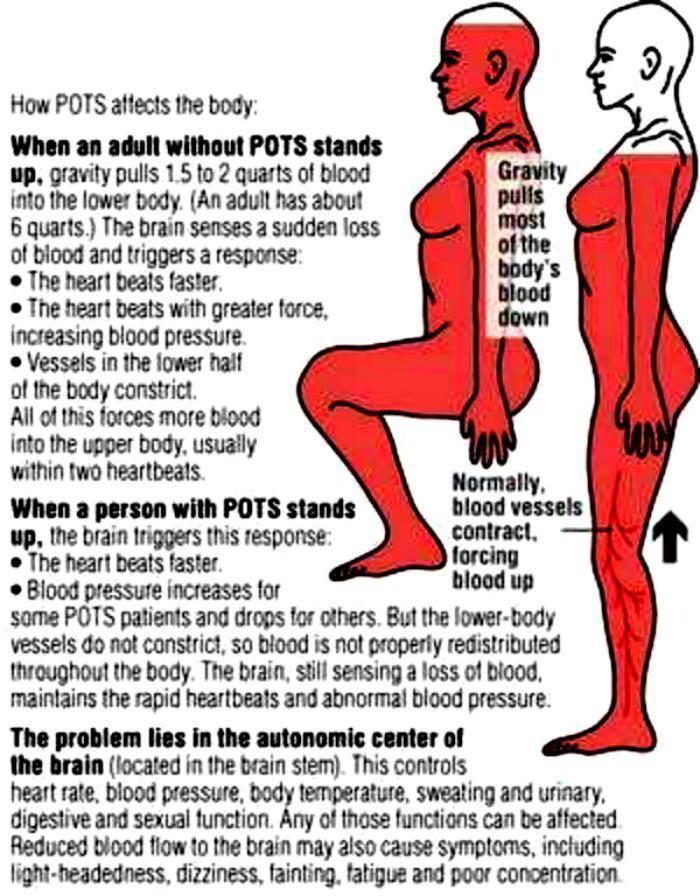 Diagnosis and management of postural orthostatic tachycardia syndrome