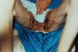 McDonalds coffee burn injuries