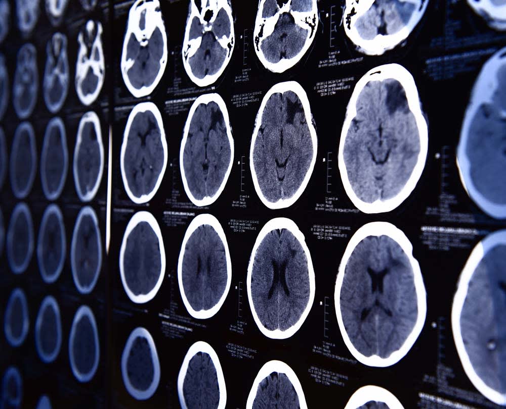 Recoverable Damages in Richmond Traumatic Brain Injury Cases