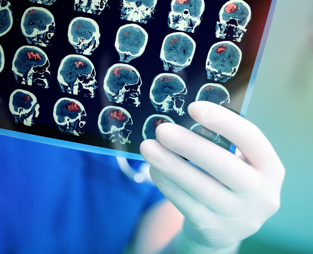 What to Look for in a Richmond Traumatic Brain Injury Lawyer