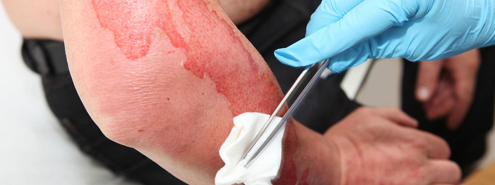 5 Things You Should Never Do After a Serious Burn