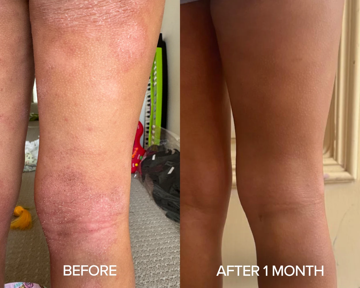 Before and after photos showing complete healing of leg eczema