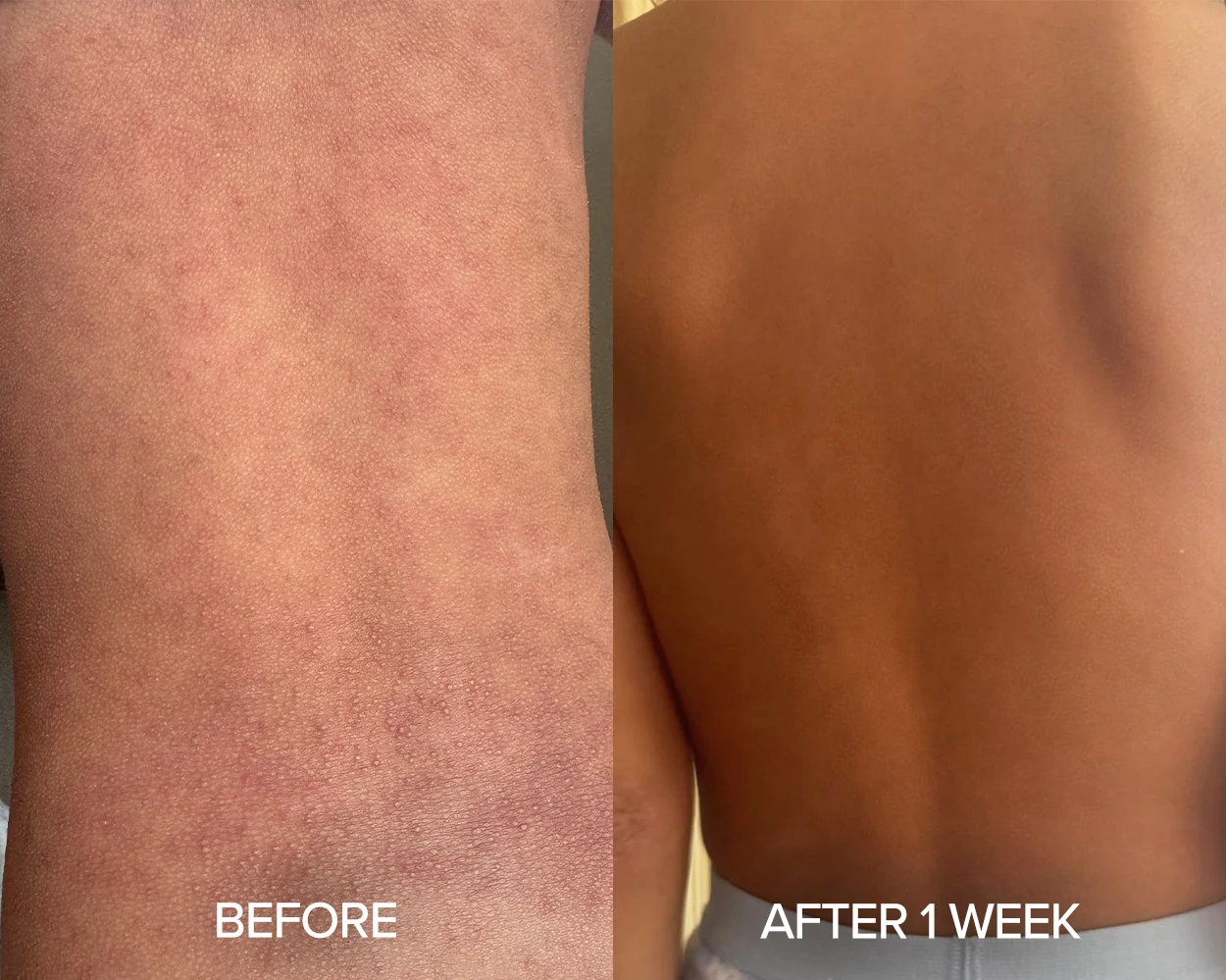 Before and after photos showing significant improvement of back eczema