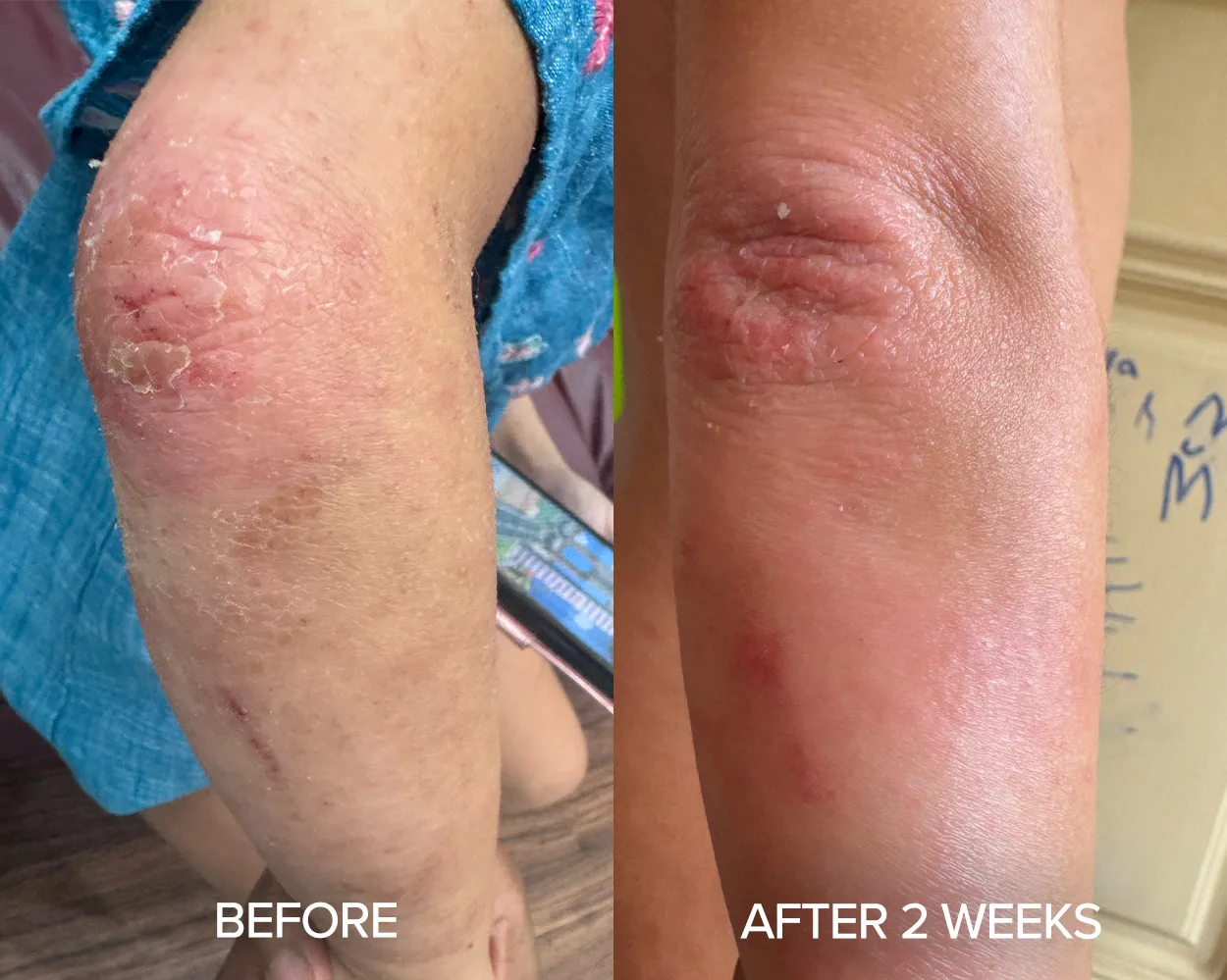Before and after photos showing significant improvement of elbow eczema