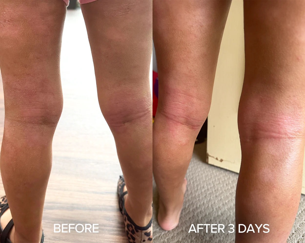 Before and after photos showing significant improvement of leg eczema
