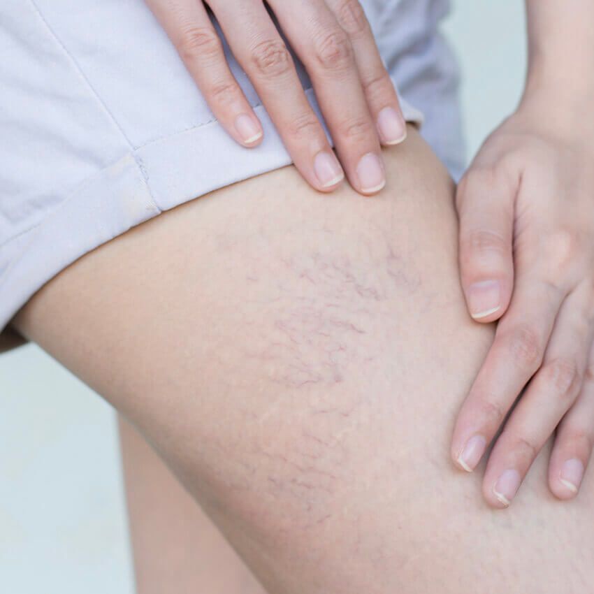 How Vein Therapy Helps Treat Pain, Swelling, and Discoloration in the Legs