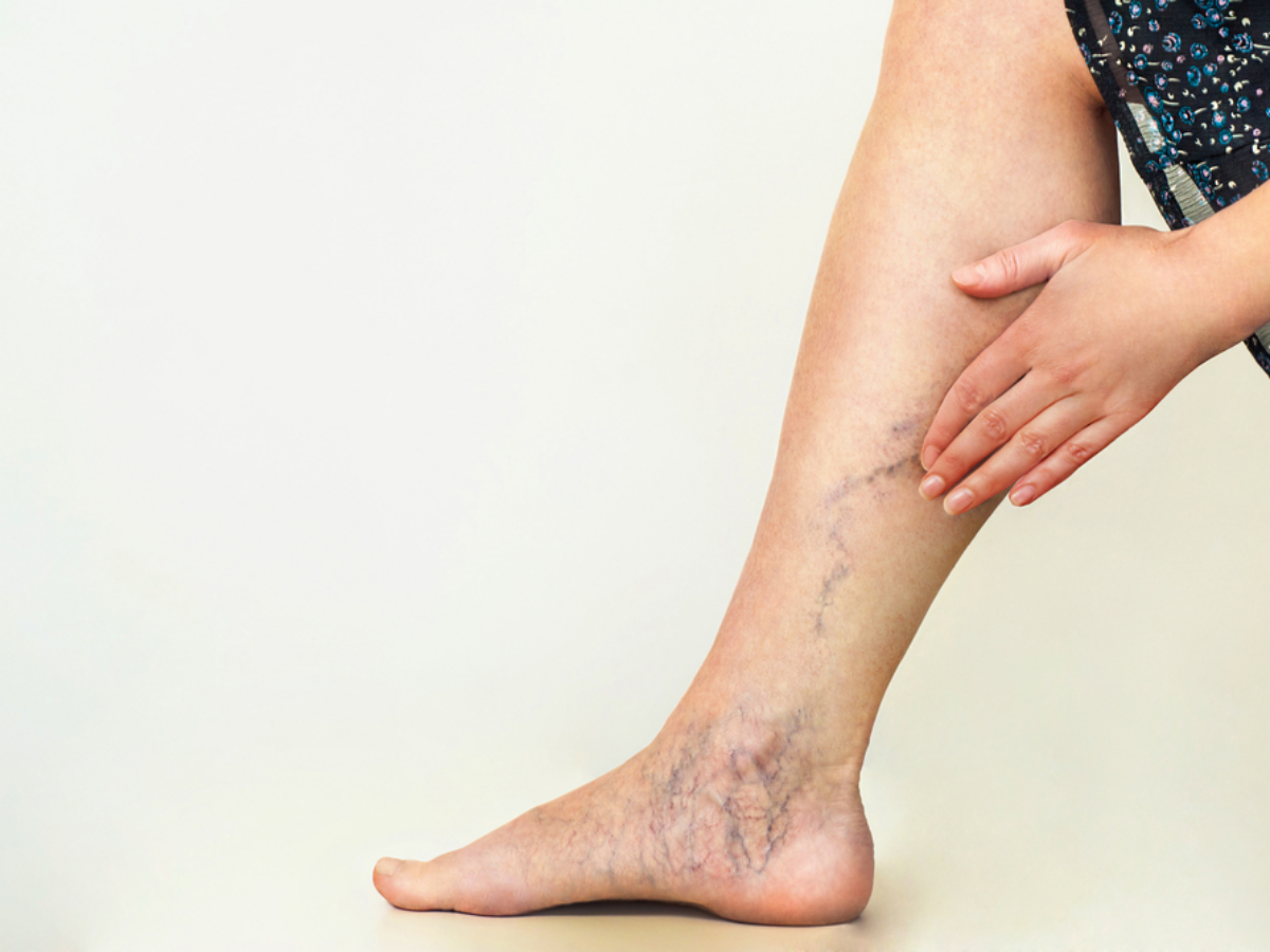 Choosing the Right Vascular Vein Clinic for Your Needs