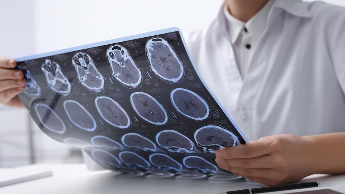 Myasthenia Gravis Patients Live Longer Than Multiple Sclerosis Myasthenia Gravis Patients Live Longer Than Multiple Sclerosis - myasthenia gravis survival
