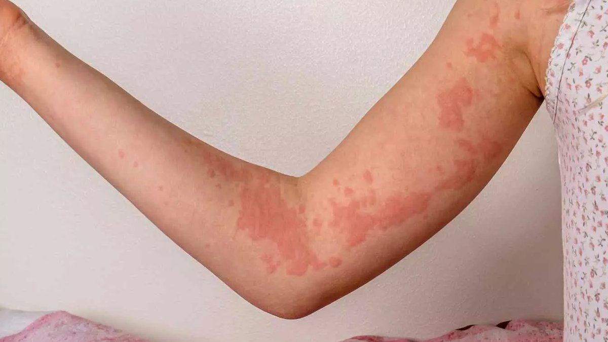 Study: Chronic Hives Often Linked to False Food Triggers