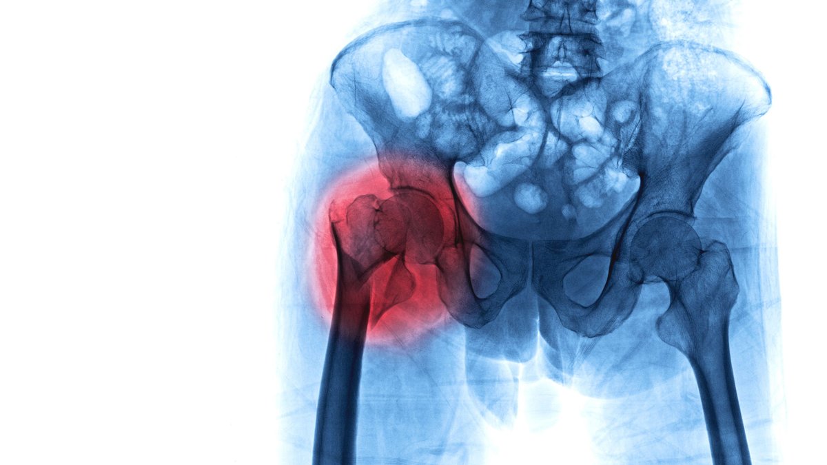 Hip fracture death risk higher with low education Hip fracture death risk higher with low education - hip fracture death risk