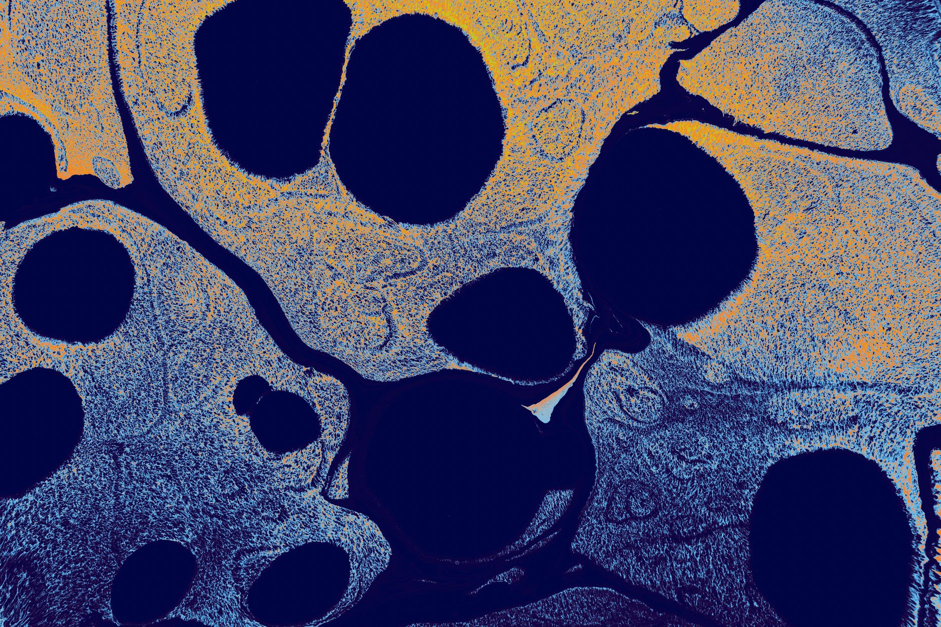 ALS Biomarker Reveals New Therapeutic Target