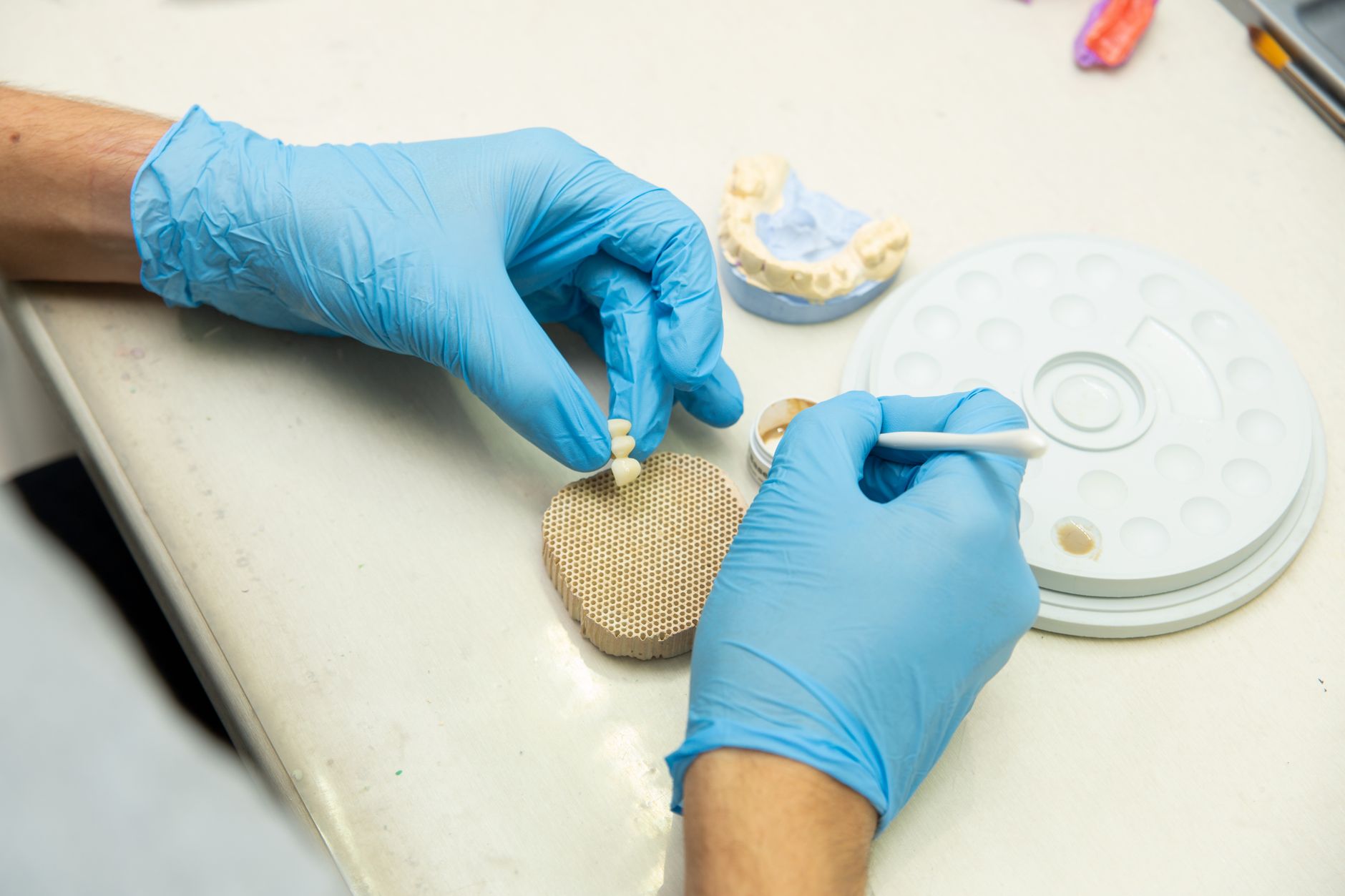 Onlay Restorations: Enhancing Strength and Longevity of Your Teeth