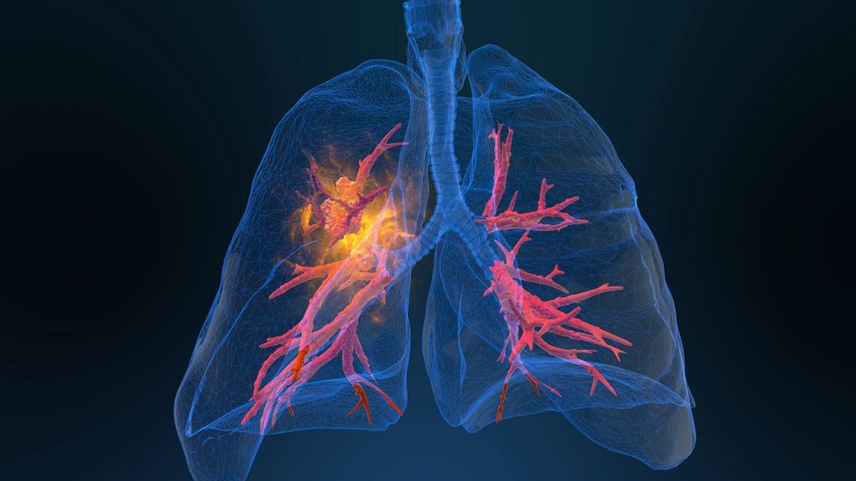 New Treatment Improves Survival in First-Line Small Cell Lung Cancer - small cell lung cancer