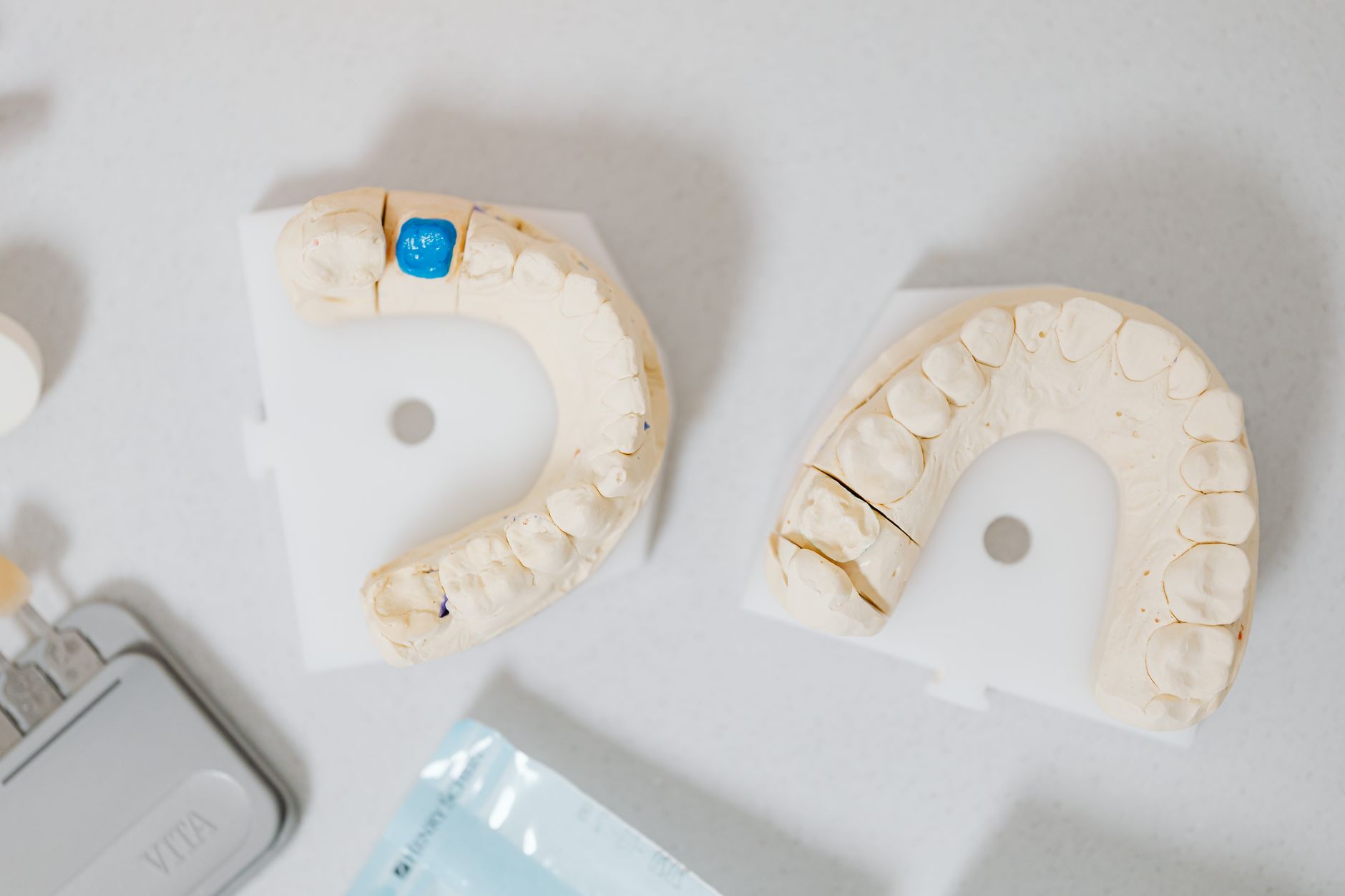 Advances in Ridge Modification: Enhancing Dental Implant Success and Oral Rehabilitation