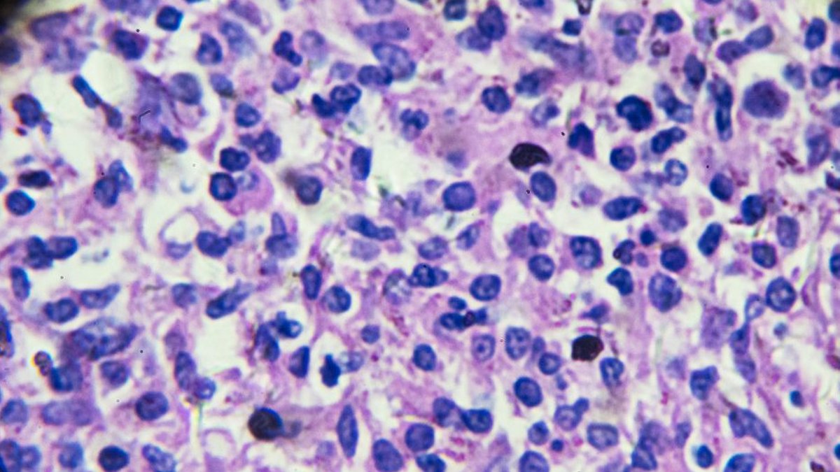 Scientists urge personalized treatment for mantle cell lymphoma - mantle cell lymphoma