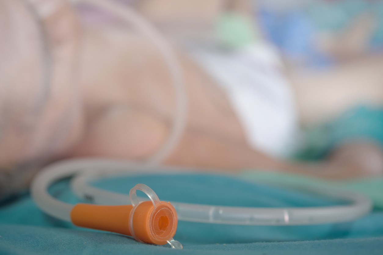 PEG feeding tube PEG feeding tube