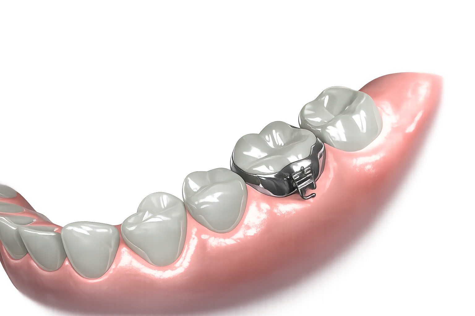 MOLAR BAND `