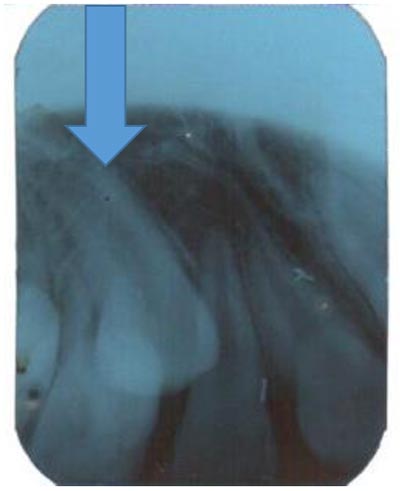 Periapical radiograph showing impacted canine