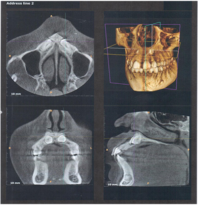 CBCT image showing impacted bilateral canine in a class II position