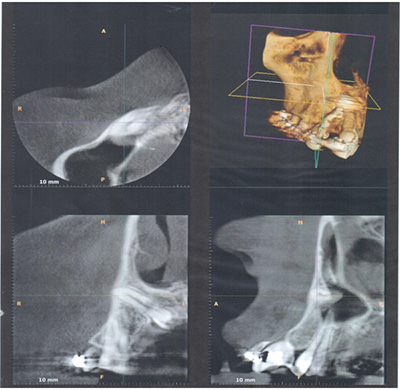 CBCT image showing unilateral impacted left canine in a class III position