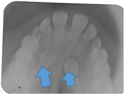 Upper Occlusal radiograph showing bilaterally impacted canines