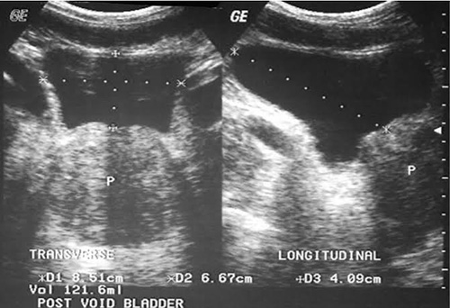 View of Clinical validity of sonographically estimated postvoid residual  volume in men with benign prostatic hyperplasia in Kano, North-West,  Nigeria