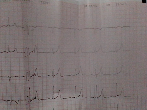 Normal sinus rhythm