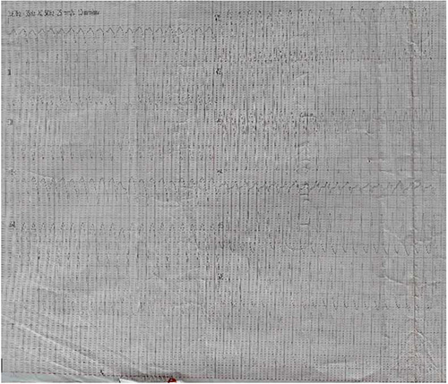 ECG showing monomorphic ventricular tachycardia (22/07/2020)