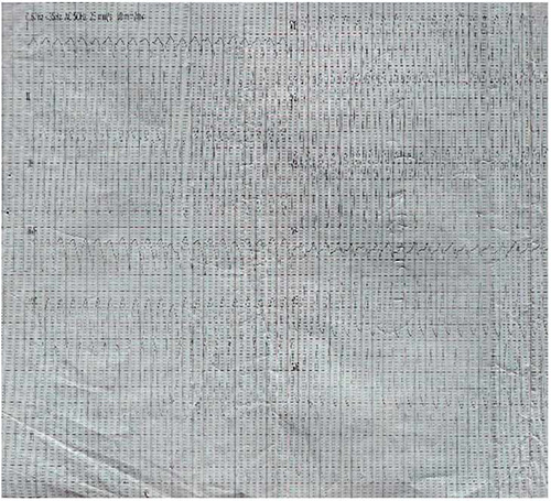 ECG showing monomorphic ventricular tachycardia (23/12/2020)