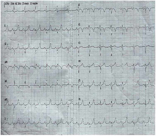 ECG after cardioversion showing sinus rhythm and septal myocardial ischemia