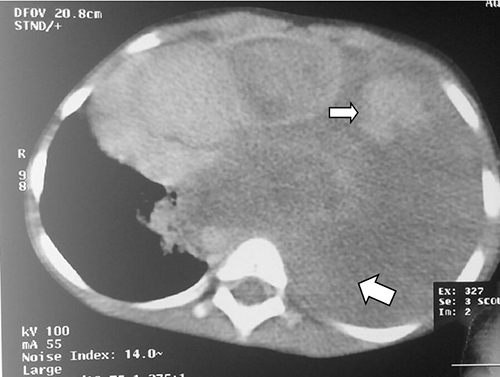 Axial contrast enhanced computed tomography of the chest showing massive left pleural effusion ( large white arrow ) and cannon ball densites (small white arrow) with mediastinal shift to the contralateral side and normal right lung field 