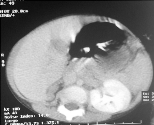 Intraoperative photograph and the excised tissue