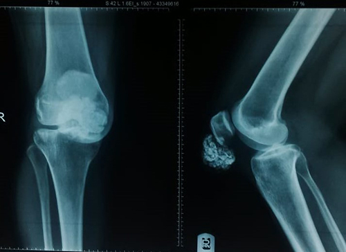 Plain radiographs of the right knee, showing calcific densities in the soft tissue close to the lower pole of the patella