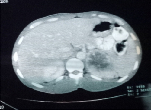 A left 7 cm pheochromocytoma seen on a CT scan