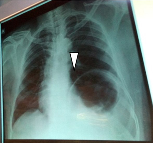 Preoperative postero-anterior chest radiograph showing the elevated dome of left hemidiaphragm (white arrow)