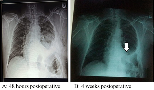 Postoperative chest x-ray with white arrow pointing to the dome of left hemidiaphragm