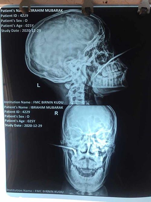 Plain radiograph of the skull showing the impacted arrow for the first case presentation.