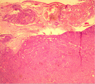 Photomicrograph showing diffuse proliferation of sheet of follicular cells with attempt at splitting the capsule and vascular invasion by the tumour cells in a case diagnosed to be follicular carcinoma in a 30-year-old male (H&E x 200).