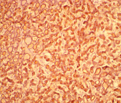 Photomicrograph of the same patient above showing diffuse staining of the cells lining the micro and macrofollicles by HBME-1 (x 200).