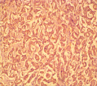 Photomicrograph of the same Figure 2 patient above showing diffuse staining of tumour cells by HBME-1. (x 200)