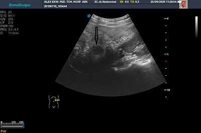 Image showing the presence of hypoechoic nodule in a patient with sickle cell anaemia (black arrow)