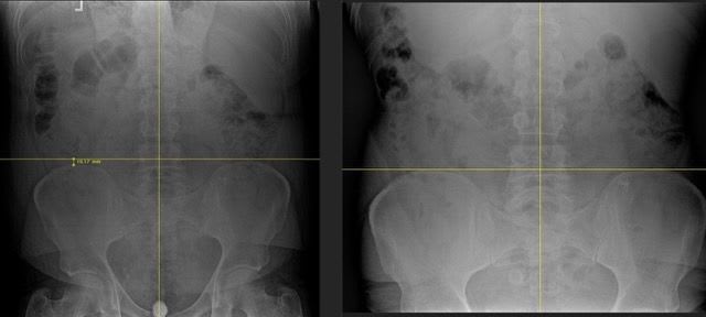 LOWER BACK PAIN & SCIATICA