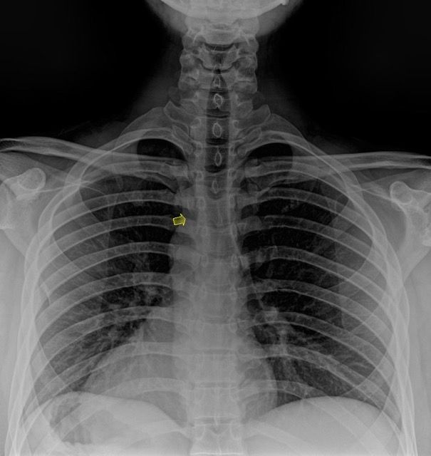 Denver Chiro Chest Pain and Rib Issues