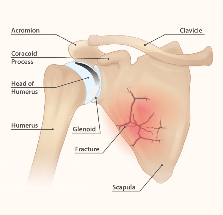 https://res.cloudinary.com/im2015/image/upload/b_rgb%3Afffaf4%2Cc_scale%2Cw_750/v1576244452/web/v2/blog/scapula_fracture.png