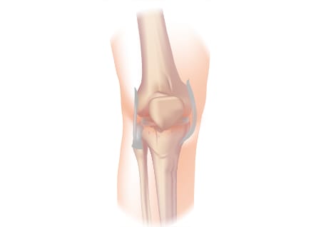 Osteoarthritis of the knee